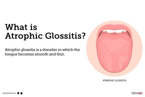 Atrophic Glossitis: Causes, Symptoms, Treatment and Cost