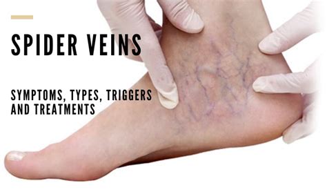 Spider Veins on Ankles - Vein Solutions