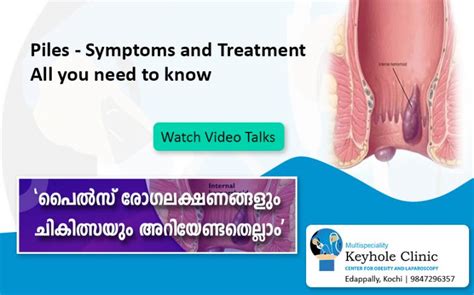 Piles Treatment | Hemorrhoids Treatment - Keyhole Clinic Kochi