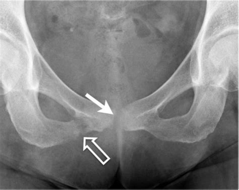 Anteroposterior radiograph of the pelvis shows a fractu | Open-i