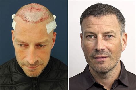 Mark Clattenburg reveals he had TWO hair transplants after 'wife said he was looking old'... and ...