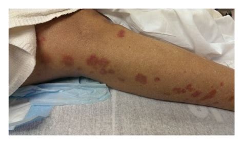 Drug-induced small vessel vasculitis. (a) Skin rash in lower ...