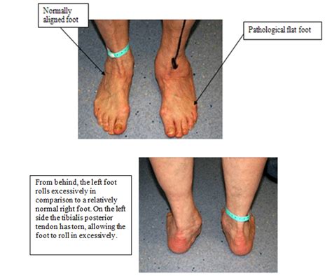 Treating the Flat Foot — Chelsea and Westminster Hospital NHS Foundation Trust