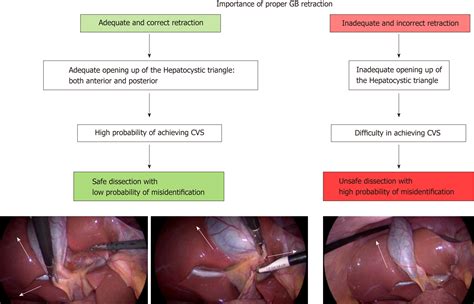 Laparoscopic Cholecystectomy Anatomy