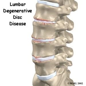 Lumbar Degenerative Disc Disease Treatment, Symptoms & Causes