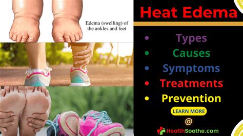 Heat Edema | Types, Causes, Symptoms, Treatments & Prevention