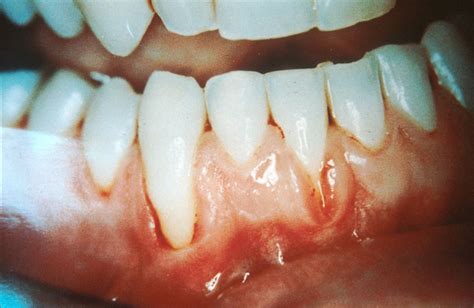 What Are White Gums? Causes And Treatment