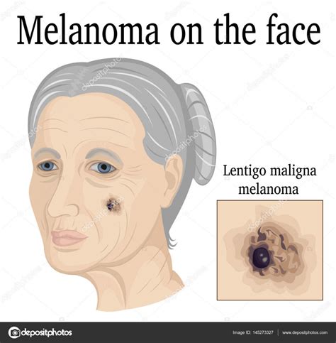 Melanoma on the face — Stock Vector © scio21.ukr.net #145273327