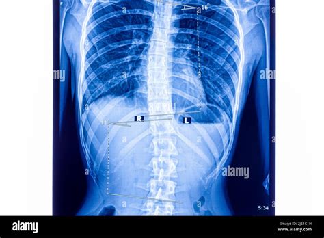 Radiografía que muestra escoliosis de la columna lumbar. La escoliosis es una curvatura lateral ...