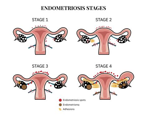 Endometriosis Fertility Index – The Big Fertility Project