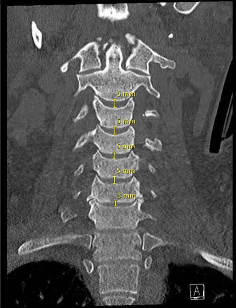 Subaxial Cervical Spine CT | Radiology Key