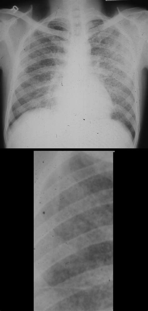 TB Miliary Disease | Lungs