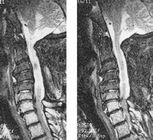 Cervical Myelomalacia treatment