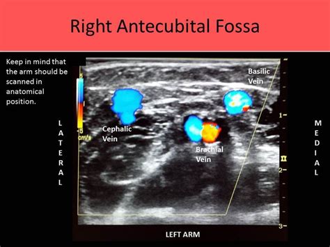 Extremity Venous | Vascular ultrasound, Diagnostic medical sonography, Echocardiogram