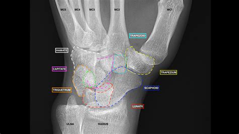 Wrist X-ray Interpretation - OSCE Guide | Geeky Medics