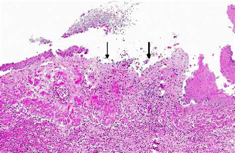 Oral Candidiasis Histology