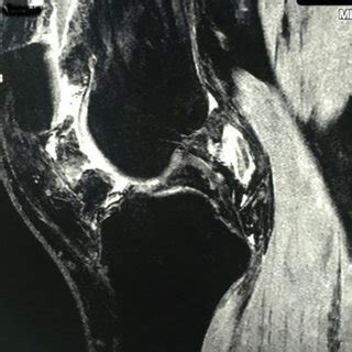 (PDF) Arthroscopic Treatment of Diffuse Pigmented Villonodular Synovitis of the Knee: Complete ...