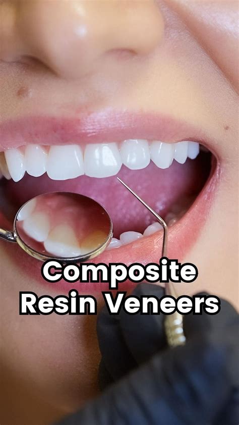 The pros and cons of composite resin dental veneers [Video] | Dental ...