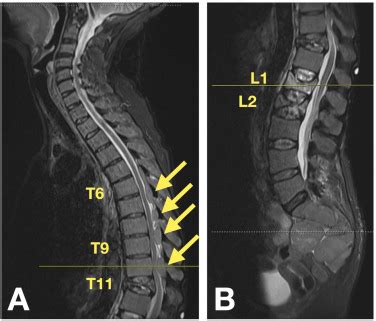 Acute spinal cord compression in the setting of chronic extramedullary hematopoiesis of the ...