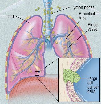 Large Cell Cancer of the Lung Guide: Causes, Symptoms and Treatment Options