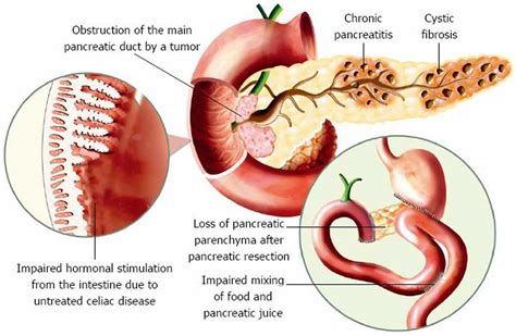 Pancreatic elastase & pancreatic elastase 1 test