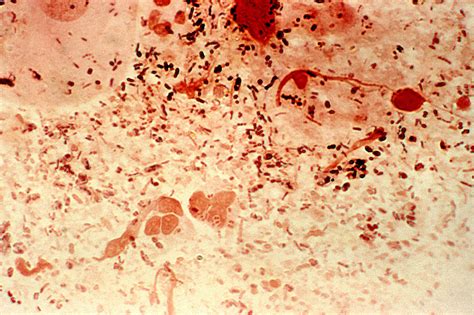 Free picture: gram, negative, neisseria, gonorrhea, bacteria, paired, hence, term, diplococci