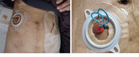 Figure 1 from Comparison of two kinds of cutaneous ureterostomy using in radical cystectomy ...