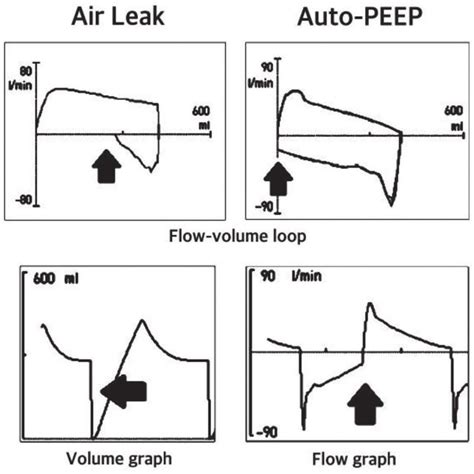 Change of volume-pressure loop depending on lung compliance.... | Download Scientific Diagram