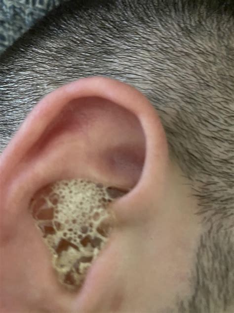 Blocked ear + Peroxide : r/earwax