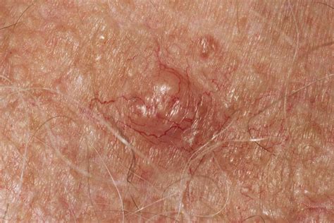 Pictures of Melanoma and Other Skin Cancers