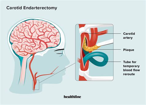 Carotid Endarterectomy FAQs: Procedure, Uses, Recovery, Risks