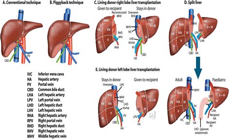 Nonvascular Post–Liver Transplantation Complications: From US Screening ...