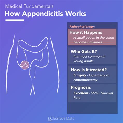 The Data on Appendicitis Without Surgery