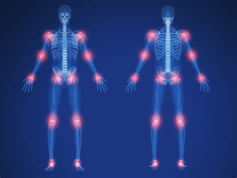 Migratory Arthritis: Causes and Related Conditions