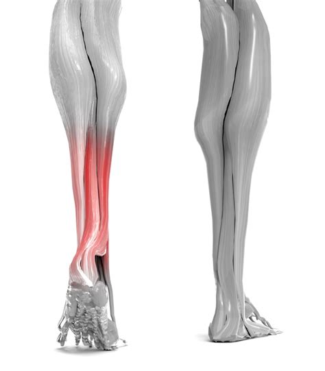 Achilles Injury and Genetics, Kentucky Orthopedic Specialists