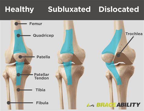 Patellar Subluxation (Partially Dislocated Kneecap) | Subluxation, Patellar tracking disorder ...