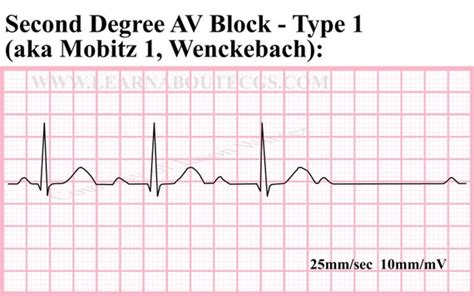 Items Similar To Second Degree Av Block Type 1 Ecg Strip On Etsy | Free ...