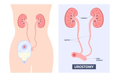 Colostomy Stoma Infection