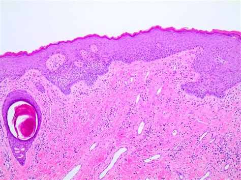 Pathology Outlines - Basal cell carcinoma-vulva