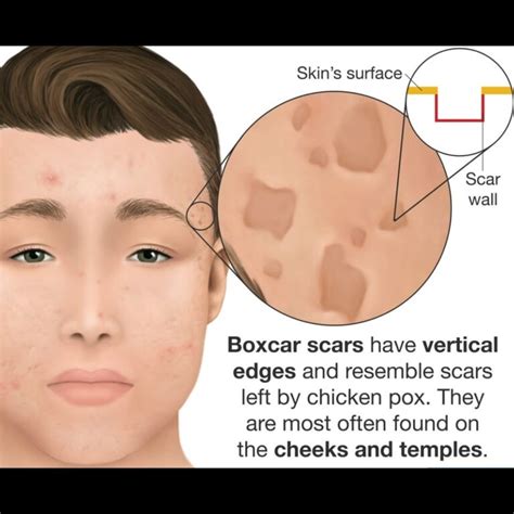 Boxcar Acne Scars - A Overview - My Acne Scars