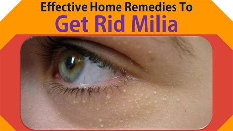 Effective Home Remedies To Milia | Get Rid Milia with Castor Oil, Lemon ...