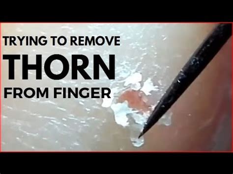 Trying to remove Thorn from finger. - YouTube