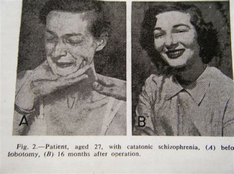 15 Lobotomy Patients Before And After Their Procedure