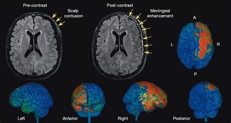 brainconcussionNIH slideshow | Mri brain, Concussions, Traumatic brain injury