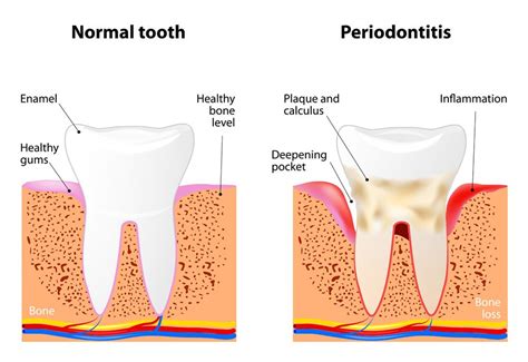 Pocket Reduction Surgery Meridian, MS - Laurel, MS - Hattiesburg, MS - J. Eric Herrington DMD