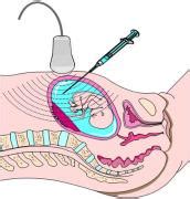 Amniocentesis procedure: when to do it, the risks involved, and the results from the OB-GYN ...