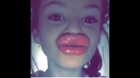 Kylie Jenner Lips Fail - Famous Person