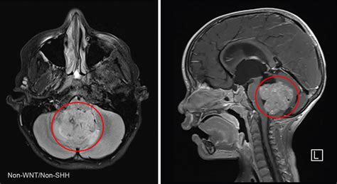 Medulloblastoma | Pediatric Brain Tumor Portal