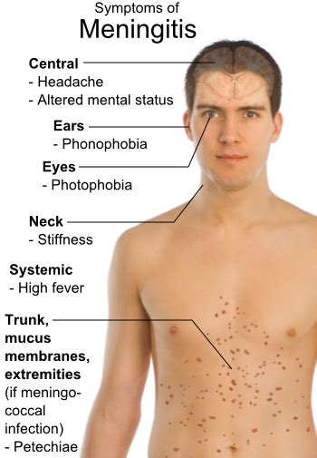 Meningococcal meningitis symptoms
