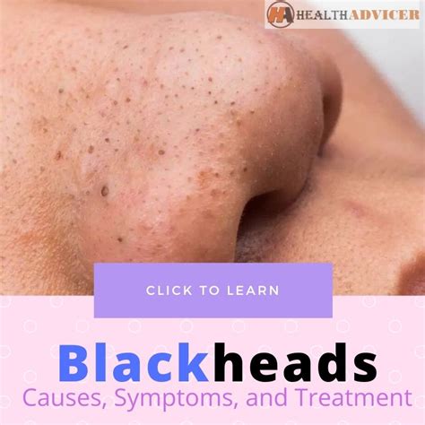 Blackheads: Causes, Symptoms, Diagnosis And Treatment